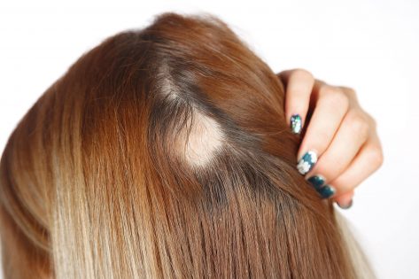 Jazvova a nejazvova alopecia